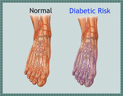 into shoes, and feet shoes deformed  regular toes shoes forcing neuropathy than rather feet for